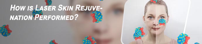 Best laser for wrinkles